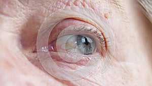 Ophthalmology. Sick Eye with dilated blood vessels of an old woman. Eye pressure. Diseases of the organs of vision