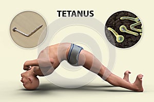 Opisthotonus in a man suffering from tetanus