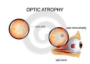 Optic nerve atrophy