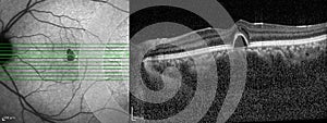 Optical Coherence Tomography