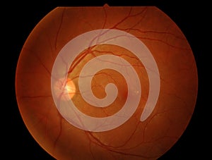 Optical Coherence Tomography