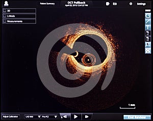 optical coherence tomography oct image angiography catheter lab atherosclerosis