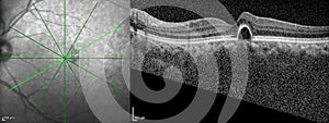 Optical Coherence Tomography