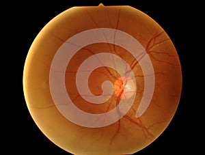 Optical Coherence Tomography