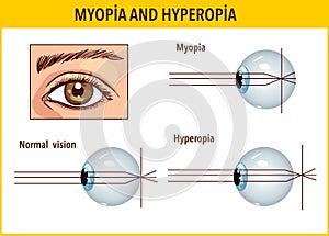 Optical human eye defects. Myopia and hyperopia. Anatomical structure of human eye, Stock vector