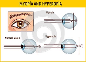 Optical human eye defects. Myopia and hyperopia. Anatomical structure of human eye, Stock vector photo