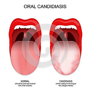 Oral candidiasis. healthy mouth and tongue with fungal infection photo