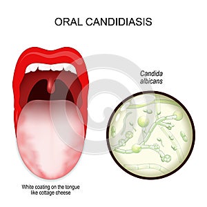 Oral candidiasis. oral thrush yeast infection