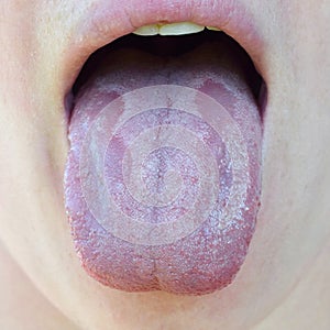 Oral Candidiasis or Oral trush Candida albicans, yeast infection on the human tongue close up, common side effect when using a