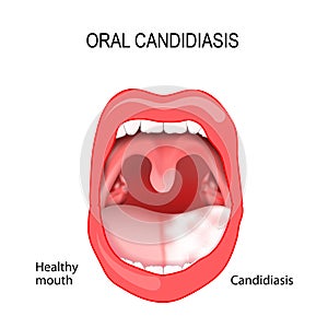 Oral candidiasis photo