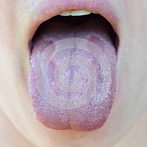 Oral Candidiasis or Oral trush Candida albicans, yeast infection on the human tongue close up, common side effect when using a photo