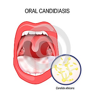 Oral candidiasis. yeast infection ofl Candida albicans the mouth