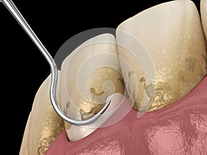 Oral hygiene: Scaling and root planing conventional periodontal therapy. Medically accurate 3D illustration