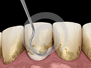 Oral hygiene: Scaling and root planing conventional periodontal therapy. Medically accurate 3D illustration photo