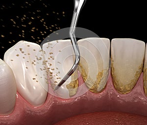 Oral hygiene: Ultrasonic teeth cleaning machine removing calculus and plaque. Medically accurate 3D illustration of human teeth