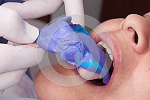 Oral rehabilitation process, partial removable prosthesis