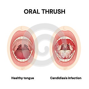 Oral thrush. Candidiasis. Symptoms.Candida infections of the mouth. Oropharyngeal candidiasis.Vector.