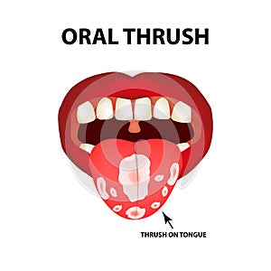 Oral thrush. Candidiasis on the tongue. Fungus in the mouth. Infographics. Vector illustration on isolated background.