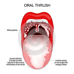 Oral thrush. A white coating on the tongue and White patches in throat