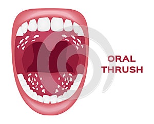 Oral thrush . white tongue