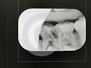 Oral xray film of patients with caries until an oral problem occurs and needs to be treated by a dentist.Healthcare and medical