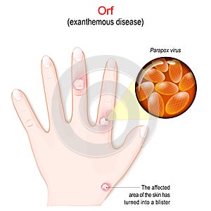 Orf. Human`s hand with The affected area of â€‹â€‹the skin