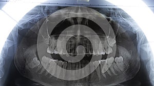 Original black and white x-ray teeth scan. Upper teeth with dental brace