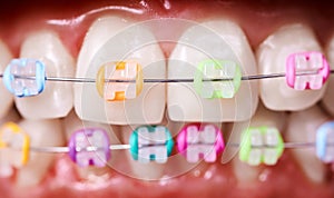 Orthodontic brackets with rubber bands on patient teeth.