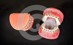 Orthodontic, denture closeup, black background