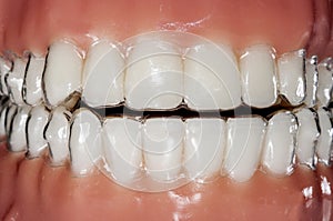 Orthodontic invisible aligner for teeth treatment photo
