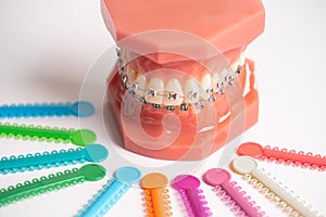 Orthodontic ligatures rings and ties, elastic rubber bands on orthodontic braces, model for dentist studying about dentistry