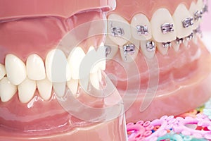 Orthodontic model.