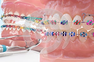 Orthodontic model.