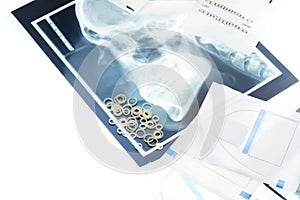 Orthodontic rubber rings and wire on xray photo