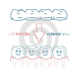 Orthodontic silicone trainer. Invisible braces aligner, retainer.