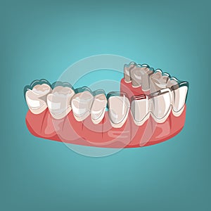 Orthodontic silicone trainer. Medical drawing in cartoon style.