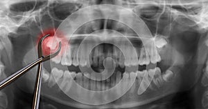 Orthodontic tool show wisdom tooth