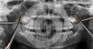 Orthodontic tools and wisdom teeth