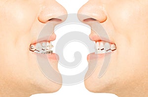 Before and after orthodontic treatment with braces photo