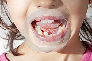 Orthodontic treatment concept image with a small girl showing her mouth.