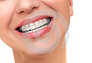 Orthodontic Treatment. Dental Brackets.