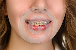 Orthodontic Treatment. Dental Care Concept. Beautiful Woman Healthy Smile close up.