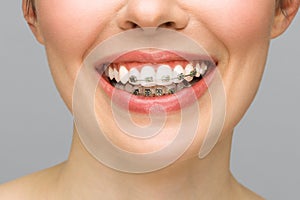 Orthodontic Treatment. Dental Care Concept. Beautiful Woman Healthy Smile close up. Closeup Ceramic and Metal Brackets