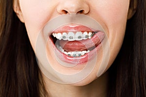 Orthodontic Treatment. Dental Care Concept. Beautiful Woman Healthy Smile close up. Closeup Ceramic and Metal Brackets