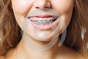 Orthodontic Treatment. Dental Care Concept. Beautiful Woman Healthy Smile close up. Closeup Ceramic and Metal Brackets photo