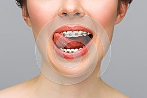 Orthodontic Treatment. Dental Care Concept. Closeup Ceramic and Metal Brackets on Teeth. Beautiful Female Smile with