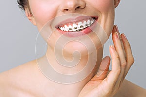 Orthodontic treatment. Dental care concept.Healthy smile close up. Closeup ceramic and metal brackets on teeth