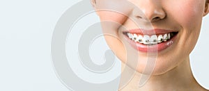 Orthodontic treatment. Dental care concept.Healthy smile close up. Closeup ceramic and metal brackets on teeth