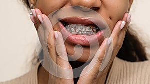 Orthodontic treatment. Teeth with braces