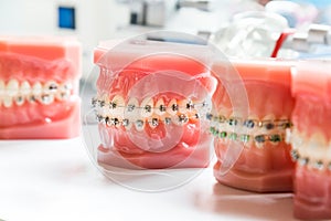 Orthodontics dental braces on teeth model to align teeth